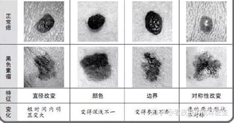 生殖器黑痣|医生，我阴茎阴囊长了很多痣，是什么原因呢，不痛不。